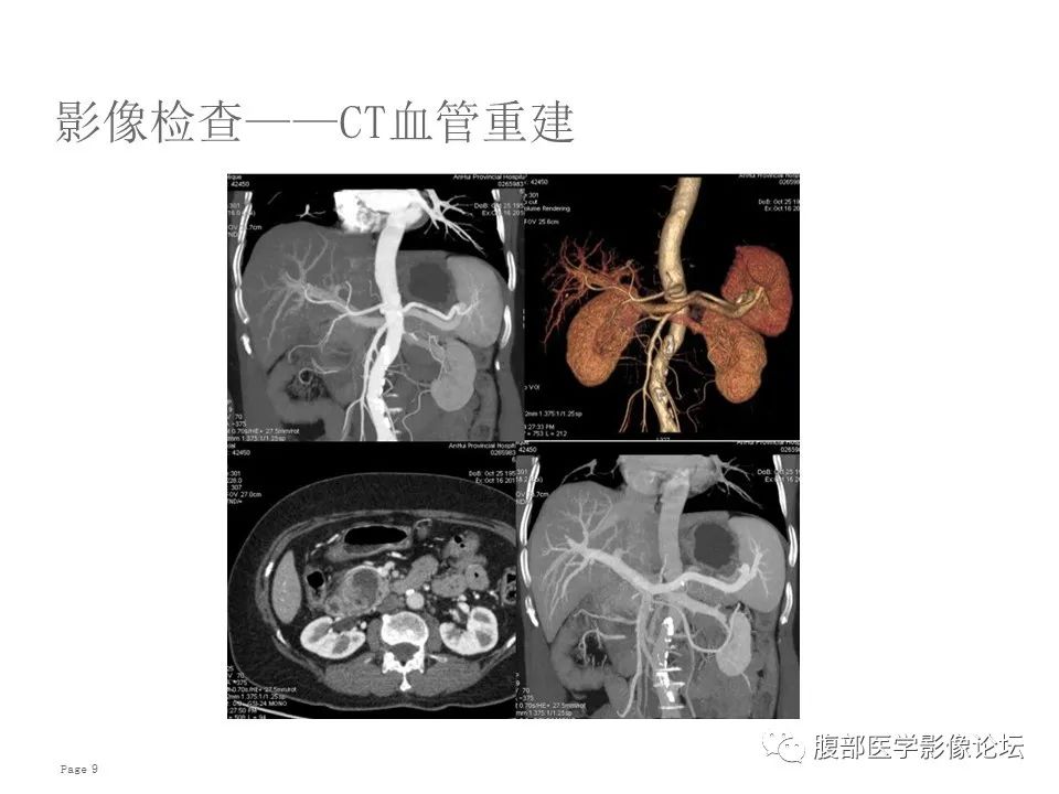 【病例】胰腺导管内乳头状粘液性肿瘤1例CT及MR影像 【病例】胰腺导管内乳头状粘液性肿瘤1例CT及MR影像