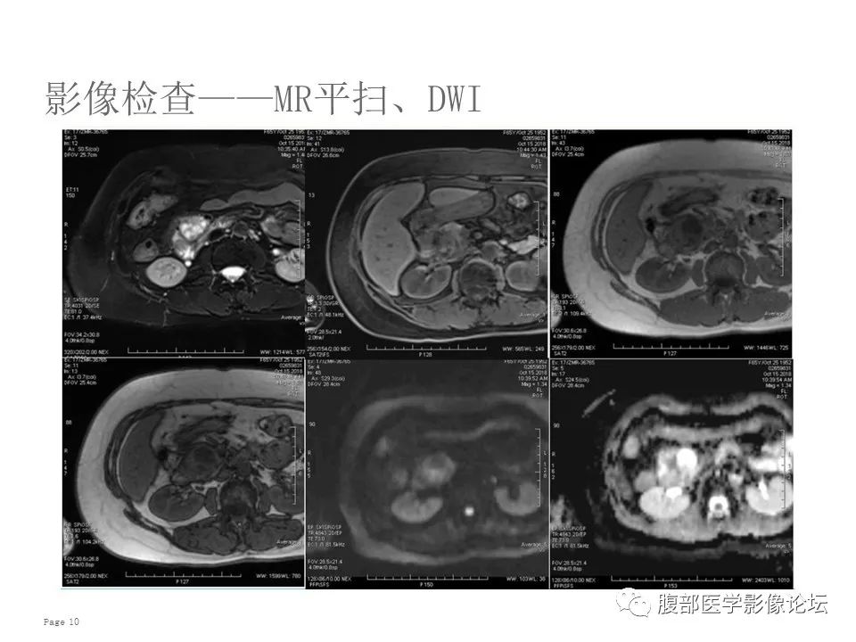 【病例】胰腺导管内乳头状粘液性肿瘤1例CT及MR影像 【病例】胰腺导管内乳头状粘液性肿瘤1例CT及MR影像