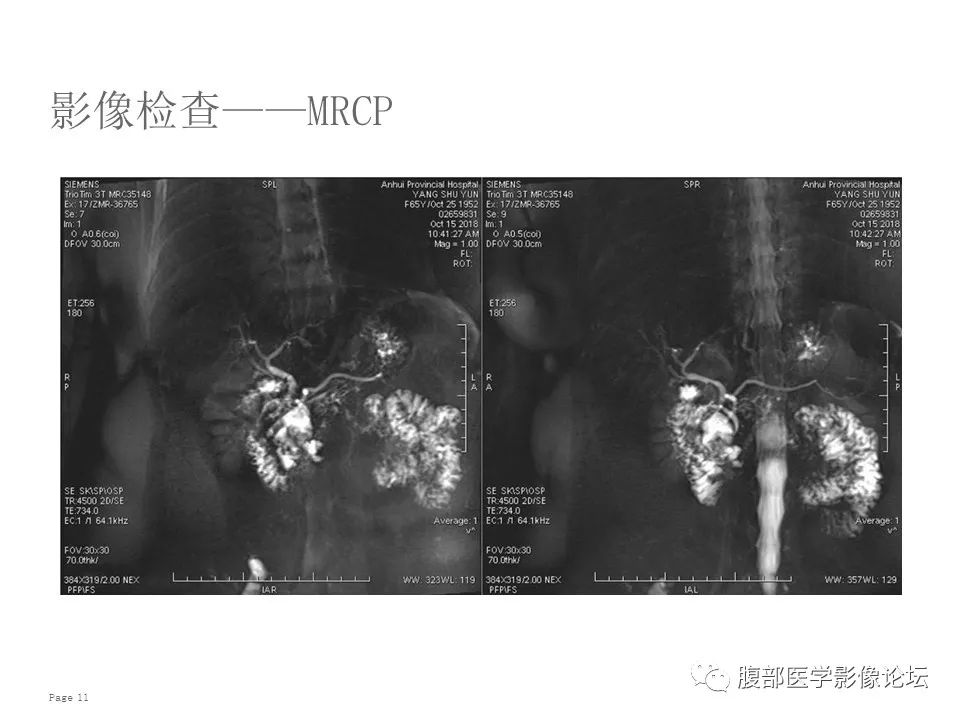 【病例】胰腺导管内乳头状粘液性肿瘤1例CT及MR影像 【病例】胰腺导管内乳头状粘液性肿瘤1例CT及MR影像