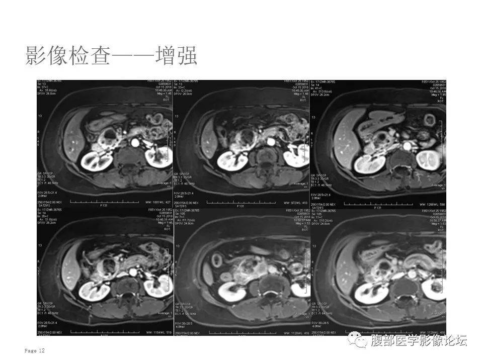 【病例】胰腺导管内乳头状粘液性肿瘤1例CT及MR影像 【病例】胰腺导管内乳头状粘液性肿瘤1例CT及MR影像