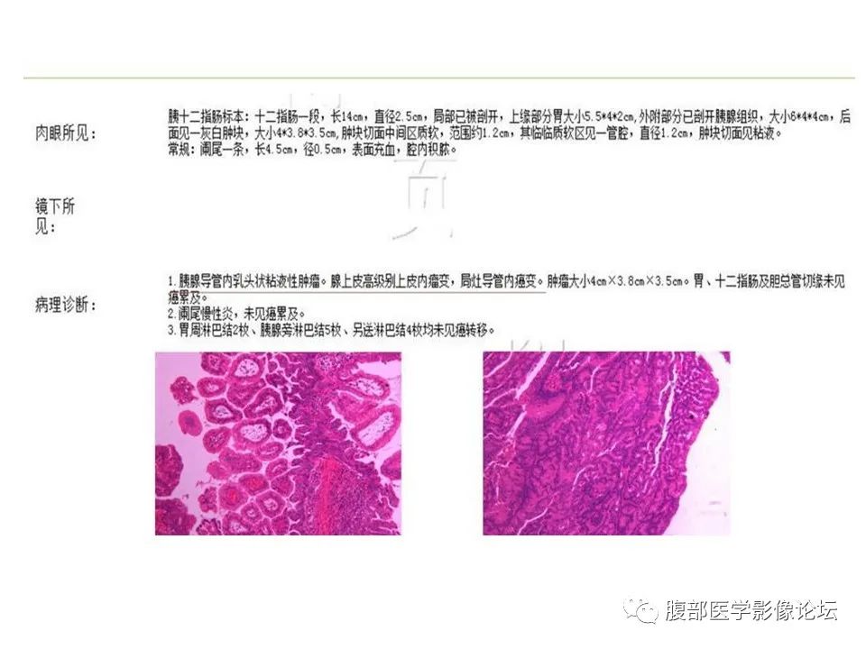 【病例】胰腺导管内乳头状粘液性肿瘤1例CT及MR影像 【病例】胰腺导管内乳头状粘液性肿瘤1例CT及MR影像