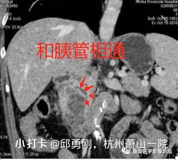 【病例】胰腺导管内乳头状粘液性肿瘤1例CT及MR影像 【病例】胰腺导管内乳头状粘液性肿瘤1例CT及MR影像