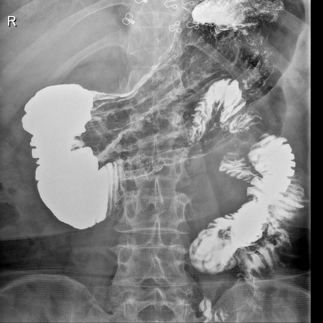 【病例】肠系膜上动脉压迫综合症1例X线造影 【病例】肠系膜上动脉压迫综合症1例X线造影