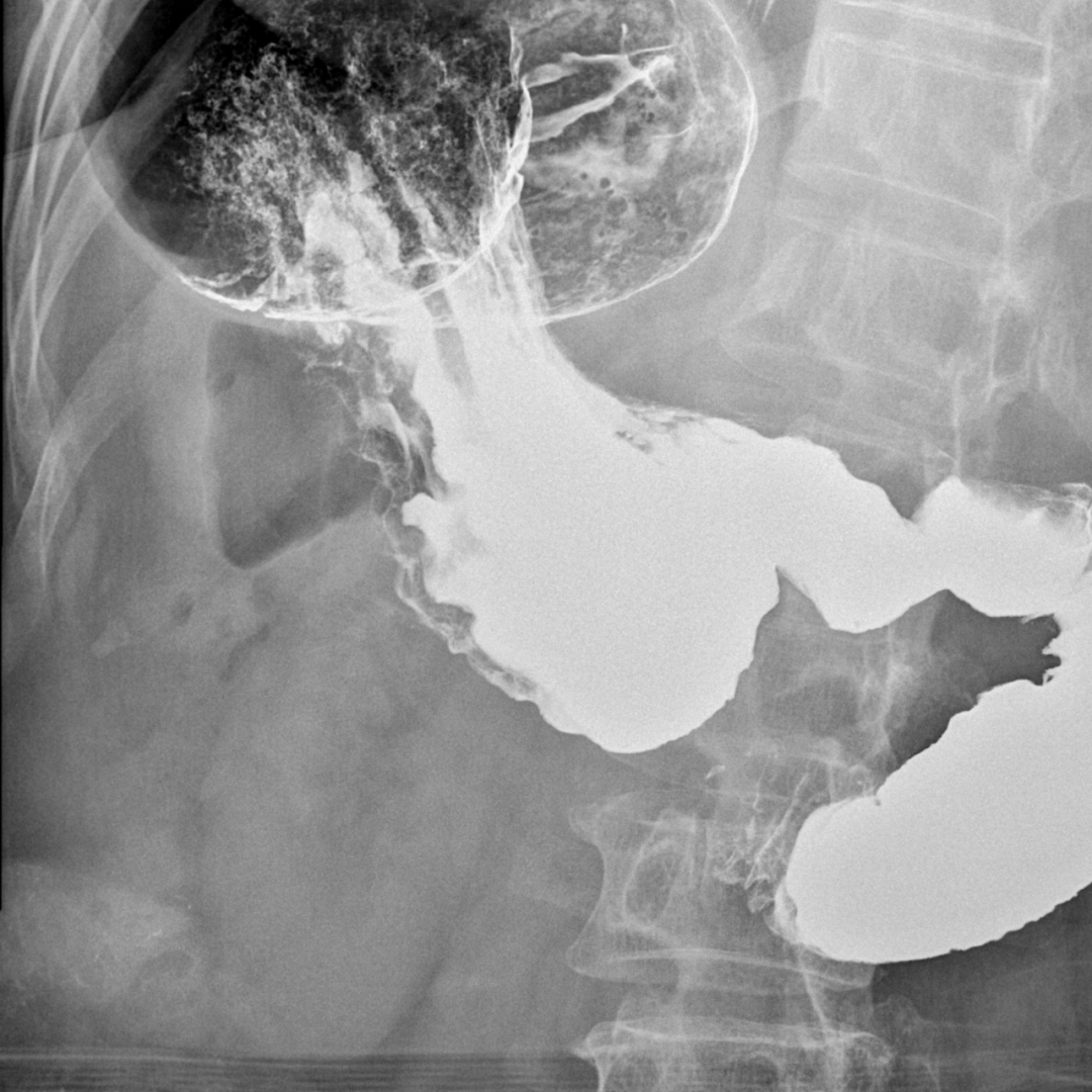 【病例】肠系膜上动脉压迫综合症1例X线造影 【病例】肠系膜上动脉压迫综合症1例X线造影