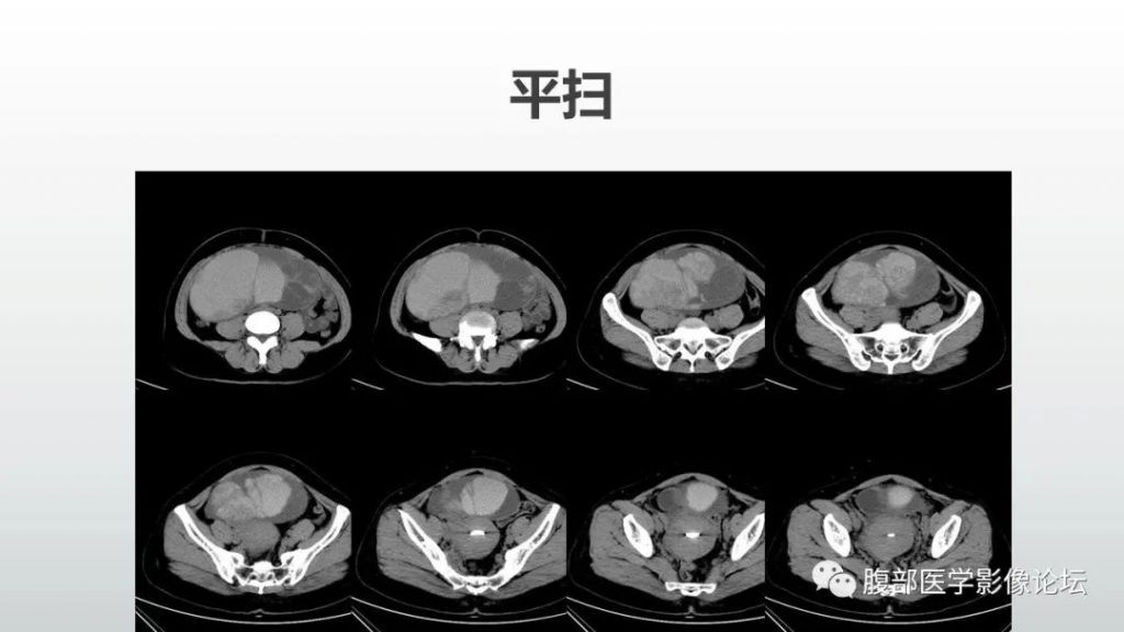 【病例】卵巢粘液性囊腺癌1例CT影像