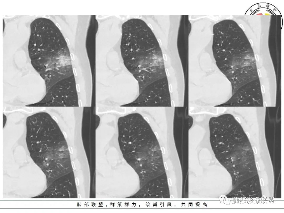 【病例】让人琢磨不透的肺肿块—肺癌1例CT影像 【病例】让人琢磨不透的肺肿块—肺癌1例CT影像