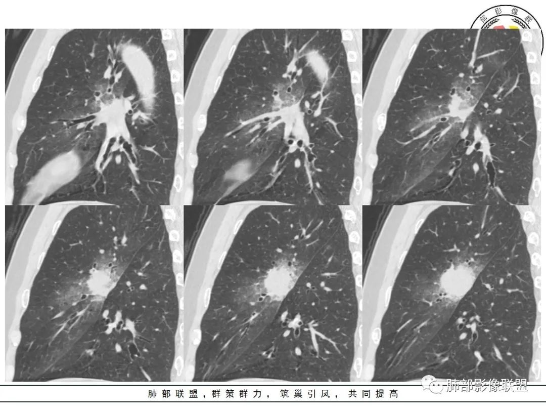 【病例】让人琢磨不透的肺肿块—肺癌1例CT影像 【病例】让人琢磨不透的肺肿块—肺癌1例CT影像