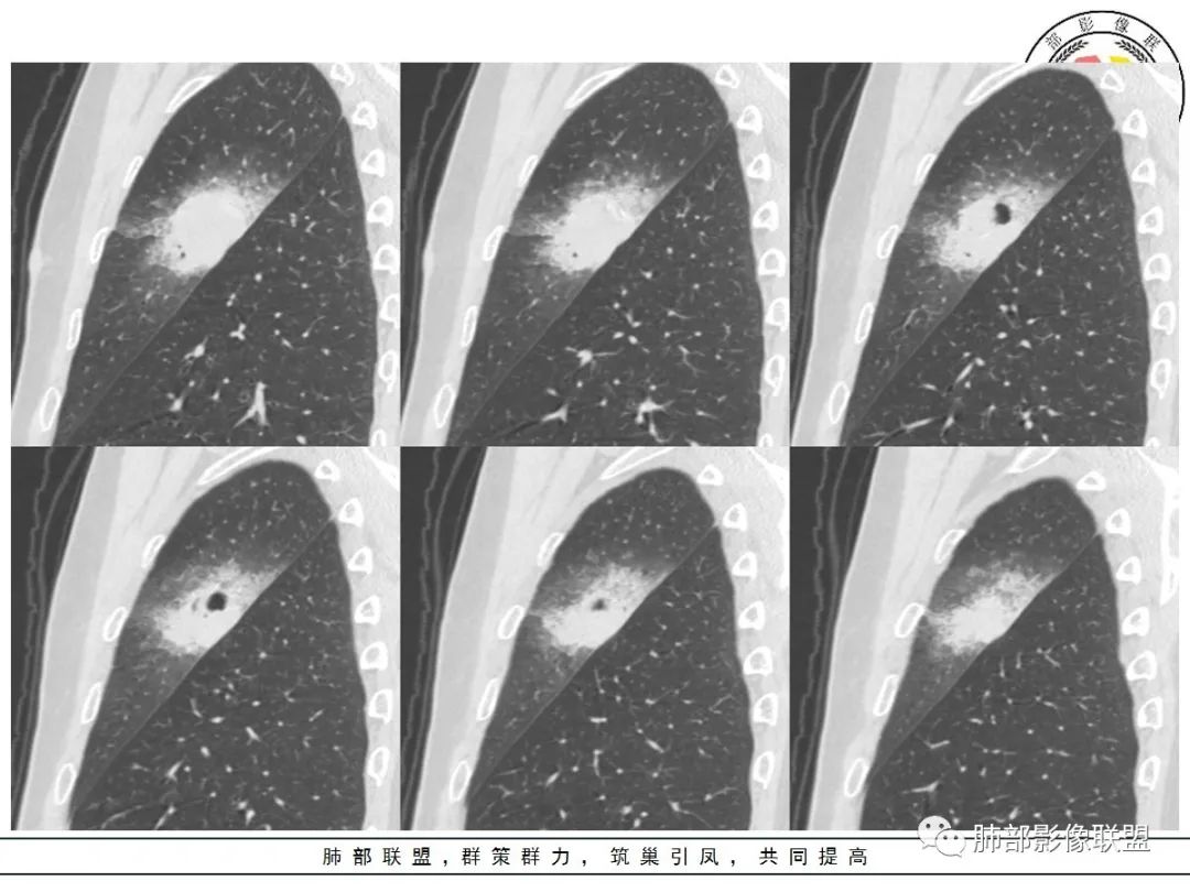【病例】让人琢磨不透的肺肿块—肺癌1例CT影像 【病例】让人琢磨不透的肺肿块—肺癌1例CT影像