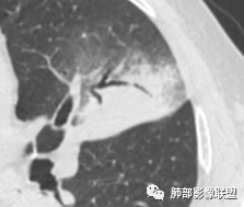 【病例】让人琢磨不透的肺肿块—肺癌1例CT影像 【病例】让人琢磨不透的肺肿块—肺癌1例CT影像