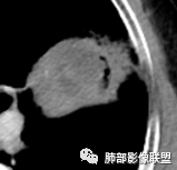 【病例】让人琢磨不透的肺肿块—肺癌1例CT影像 【病例】让人琢磨不透的肺肿块—肺癌1例CT影像