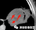 【病例】让人琢磨不透的肺肿块—肺癌1例CT影像 【病例】让人琢磨不透的肺肿块—肺癌1例CT影像