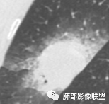 【病例】让人琢磨不透的肺肿块—肺癌1例CT影像 【病例】让人琢磨不透的肺肿块—肺癌1例CT影像