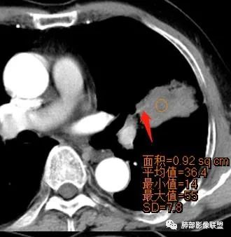 【病例】让人琢磨不透的肺肿块—肺癌1例CT影像 【病例】让人琢磨不透的肺肿块—肺癌1例CT影像