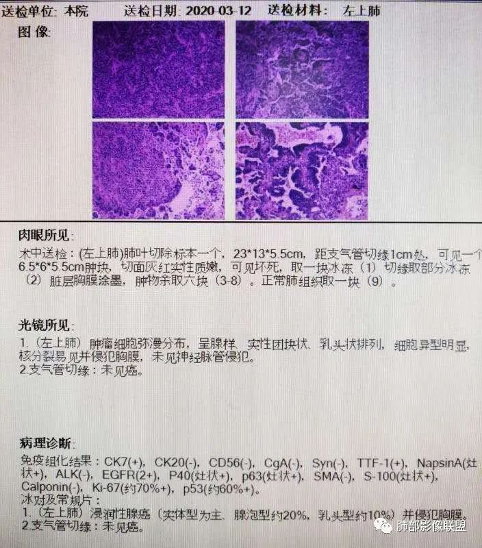【病例】让人琢磨不透的肺肿块—肺癌1例CT影像 【病例】让人琢磨不透的肺肿块—肺癌1例CT影像