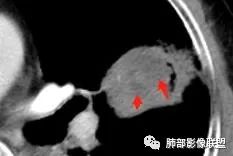 【病例】让人琢磨不透的肺肿块—肺癌1例CT影像 【病例】让人琢磨不透的肺肿块—肺癌1例CT影像