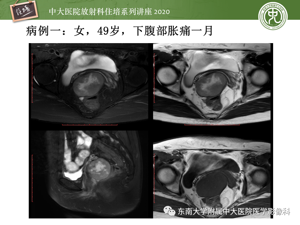 【PPT】女性盆腔实性占位性病变定位分析