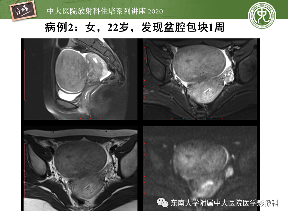 【PPT】女性盆腔实性占位性病变定位分析