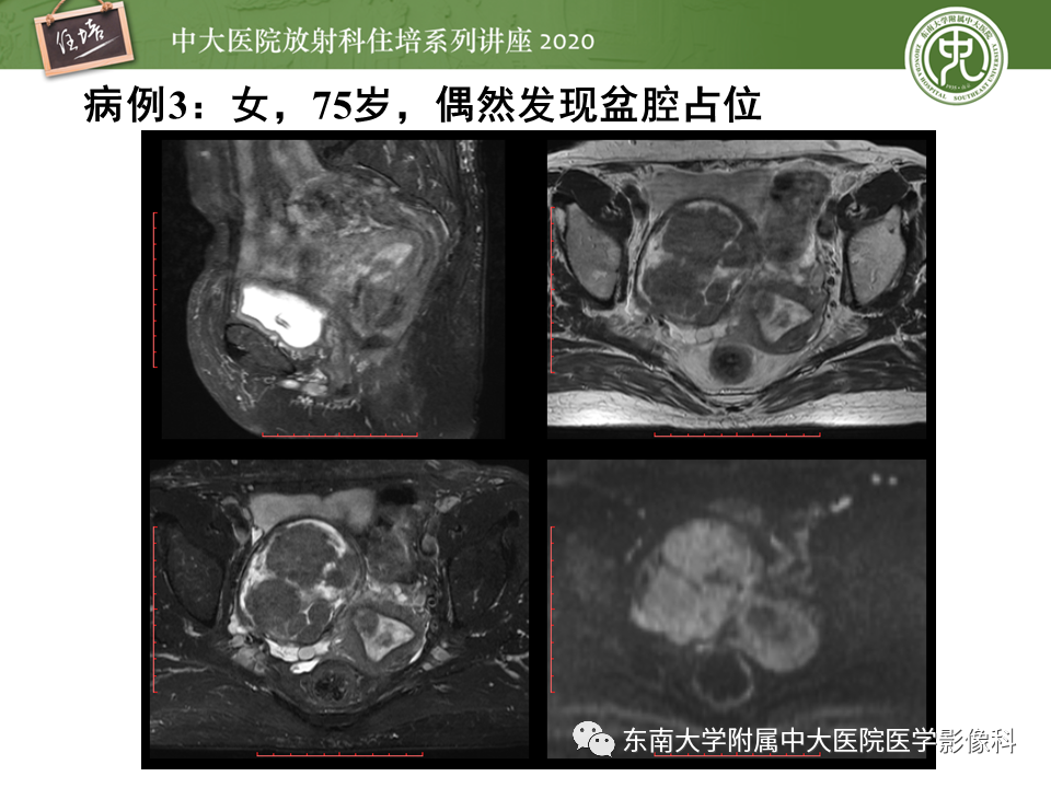 【PPT】女性盆腔实性占位性病变定位分析