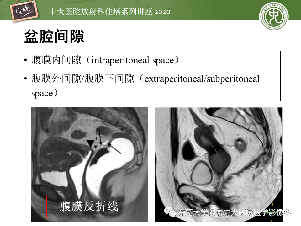 【PPT】女性盆腔实性占位性病变定位分析