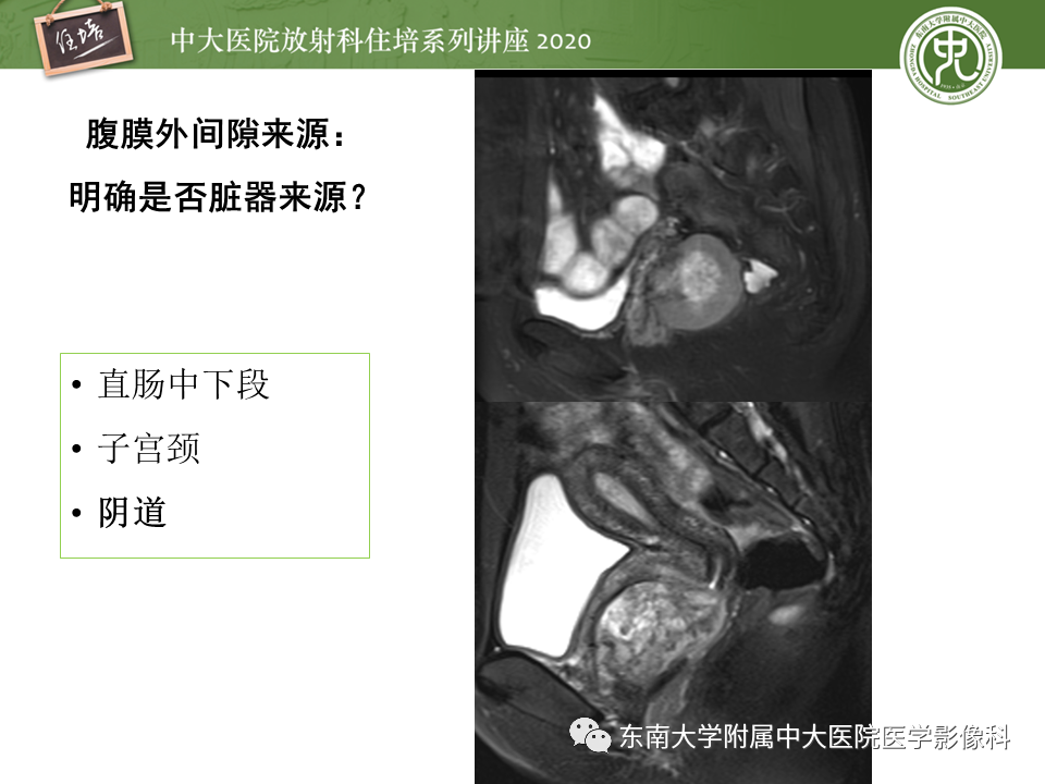 【PPT】女性盆腔实性占位性病变定位分析