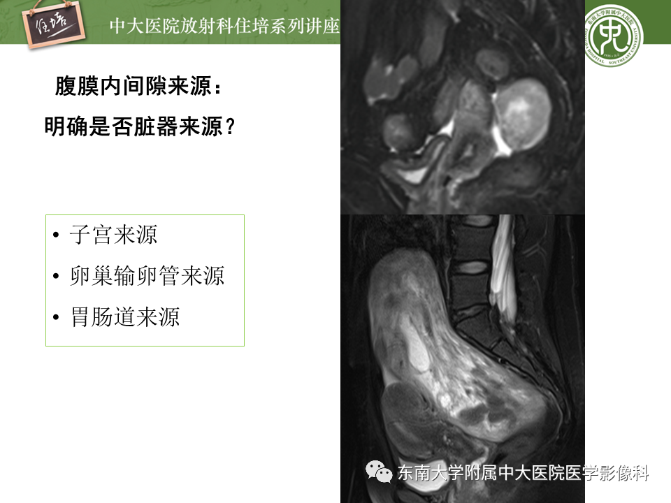 【PPT】女性盆腔实性占位性病变定位分析