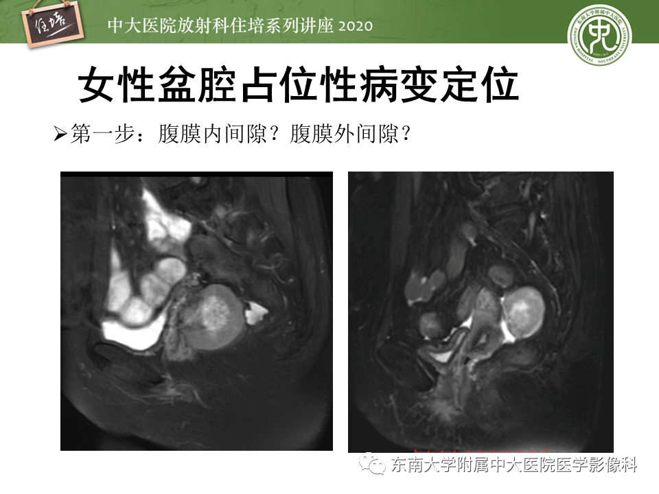【PPT】女性盆腔实性占位性病变定位分析