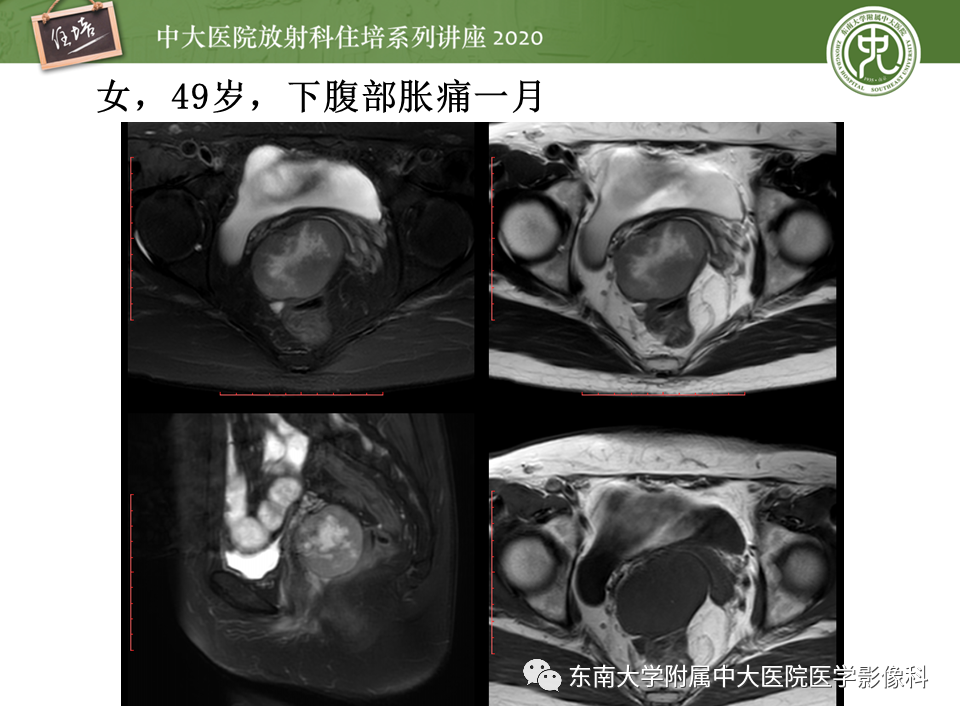 【PPT】女性盆腔实性占位性病变定位分析