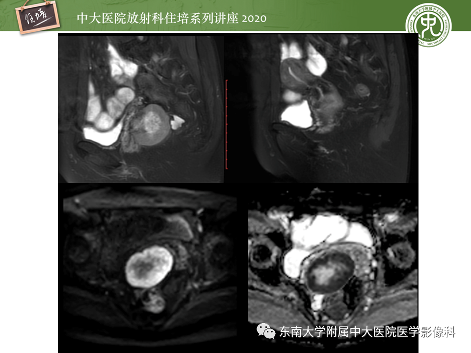 【PPT】女性盆腔实性占位性病变定位分析