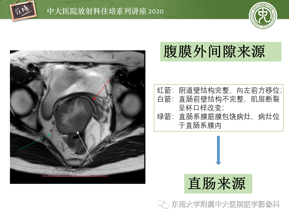 【PPT】女性盆腔实性占位性病变定位分析