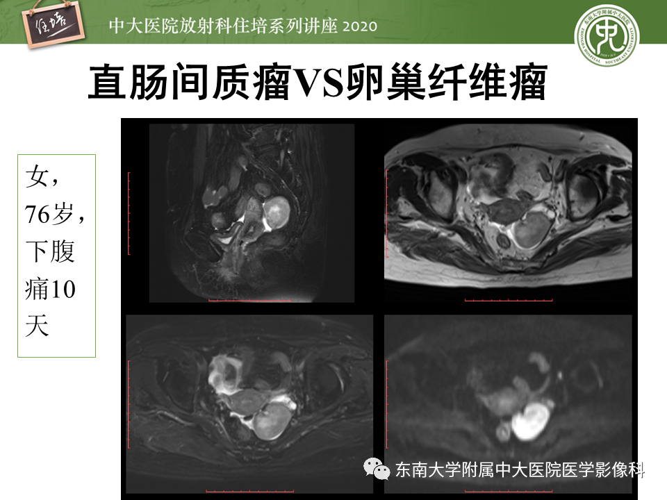 【PPT】女性盆腔实性占位性病变定位分析