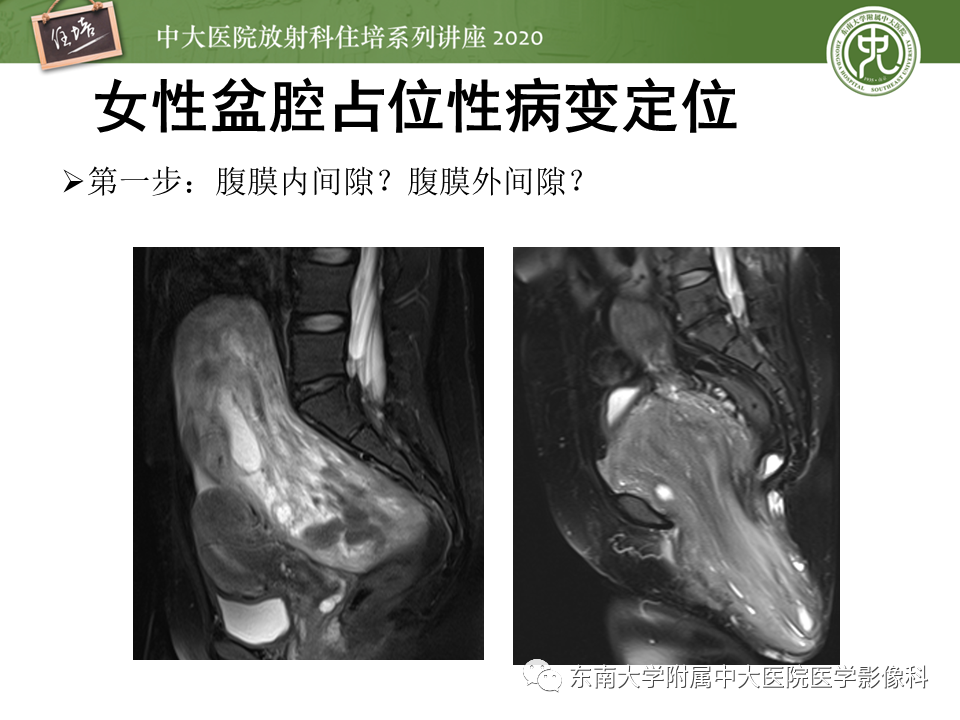【PPT】女性盆腔实性占位性病变定位分析