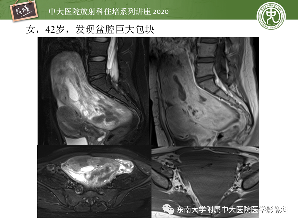 【PPT】女性盆腔实性占位性病变定位分析