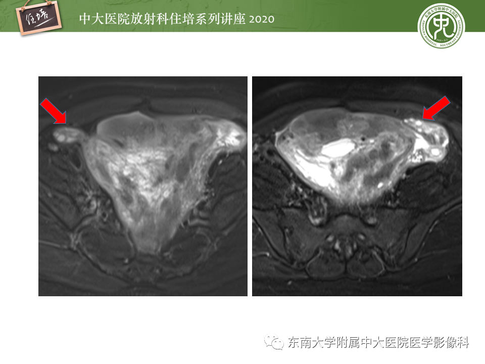 【PPT】女性盆腔实性占位性病变定位分析