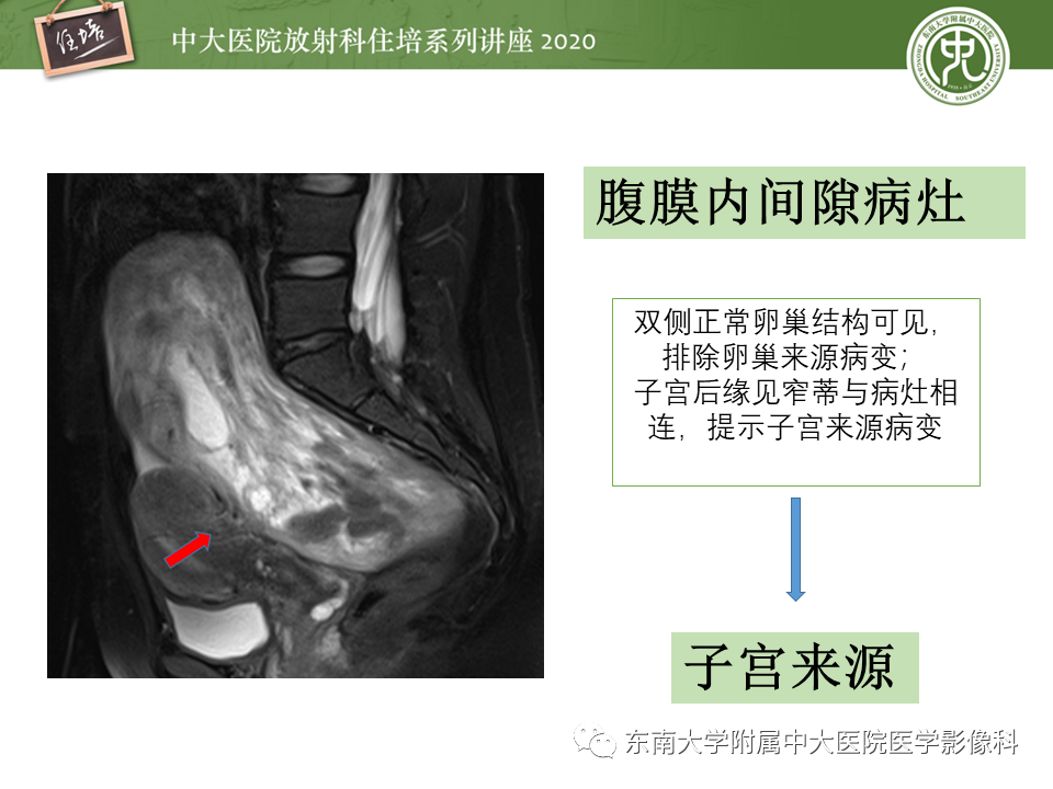 【PPT】女性盆腔实性占位性病变定位分析