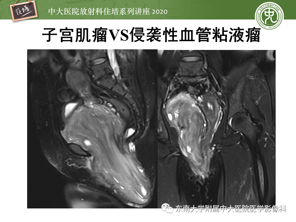 【PPT】女性盆腔实性占位性病变定位分析