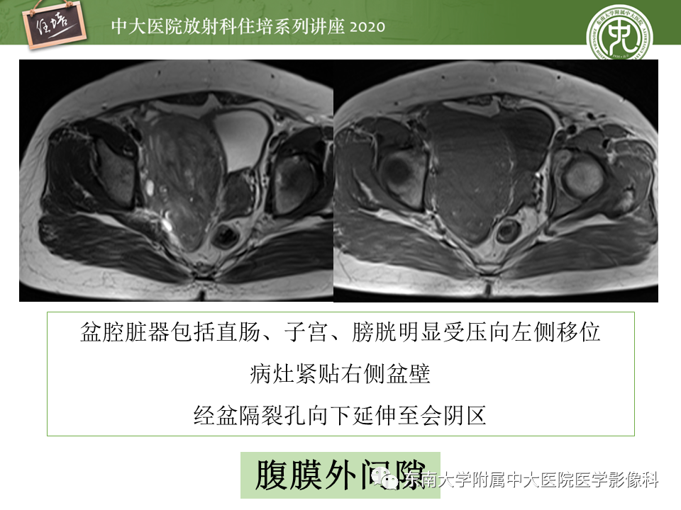 【PPT】女性盆腔实性占位性病变定位分析