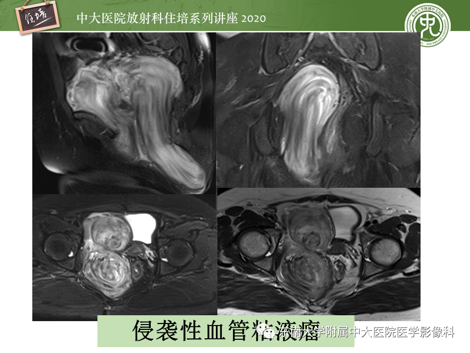 【PPT】女性盆腔实性占位性病变定位分析
