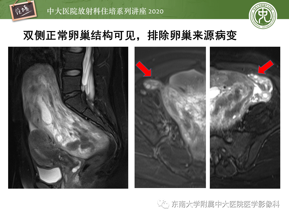 【PPT】女性盆腔实性占位性病变定位分析