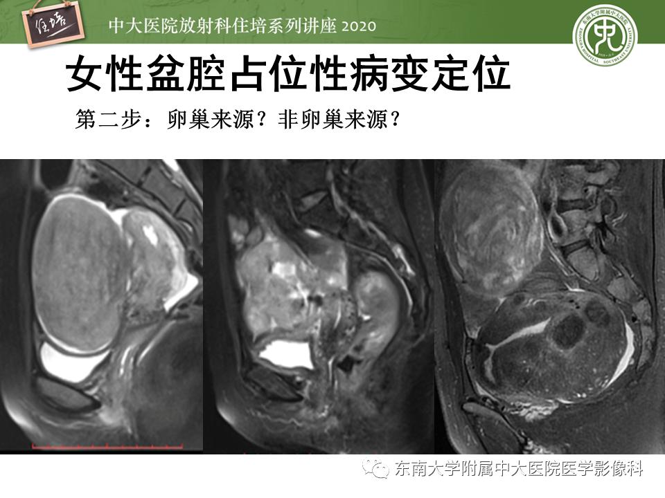 【PPT】女性盆腔实性占位性病变定位分析
