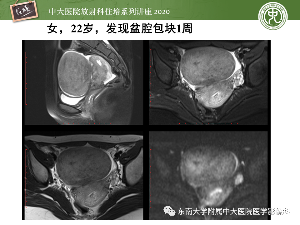 【PPT】女性盆腔实性占位性病变定位分析