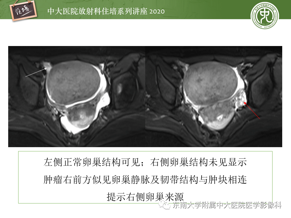 【PPT】女性盆腔实性占位性病变定位分析