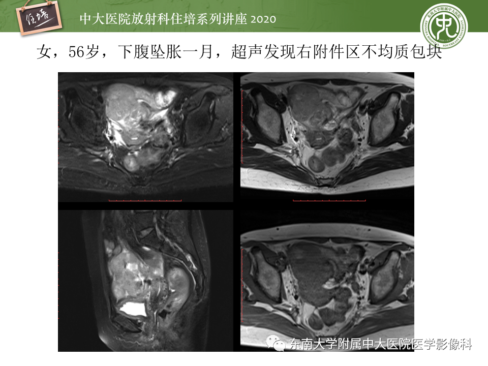 【PPT】女性盆腔实性占位性病变定位分析
