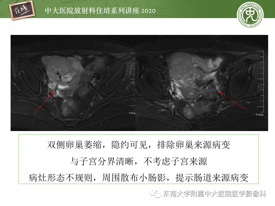 【PPT】女性盆腔实性占位性病变定位分析