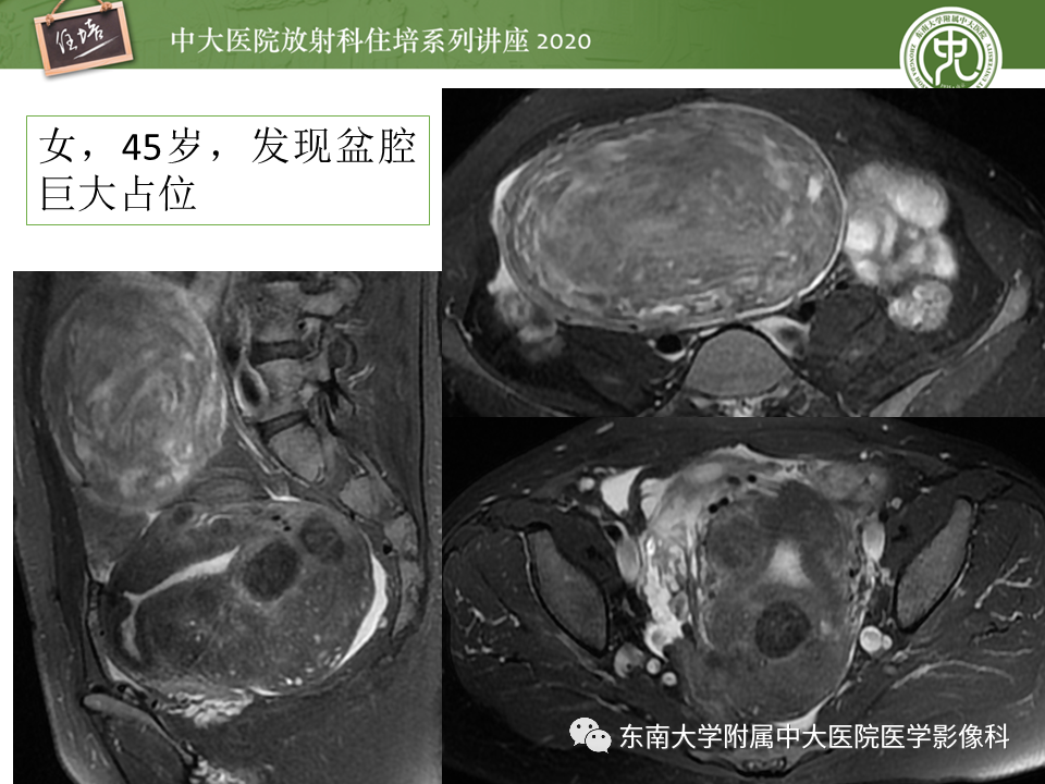 【PPT】女性盆腔实性占位性病变定位分析