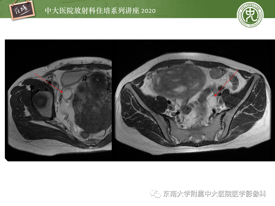 【PPT】女性盆腔实性占位性病变定位分析