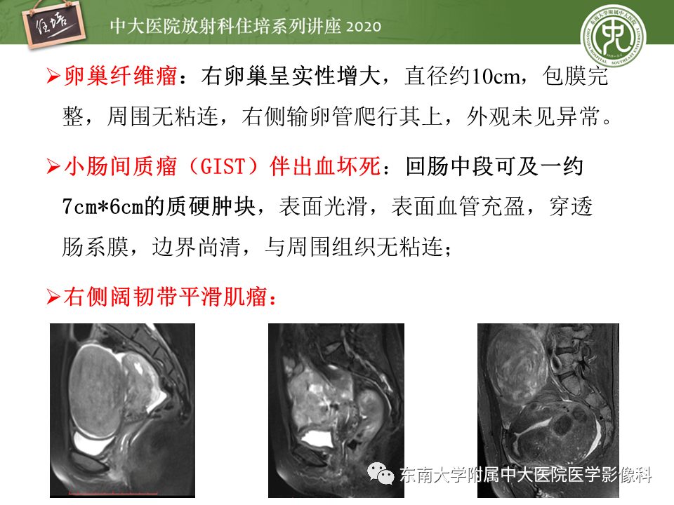 【PPT】女性盆腔实性占位性病变定位分析