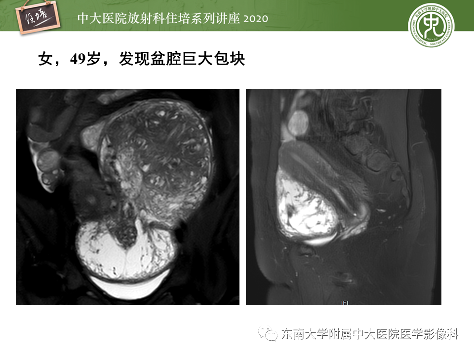 【PPT】女性盆腔实性占位性病变定位分析