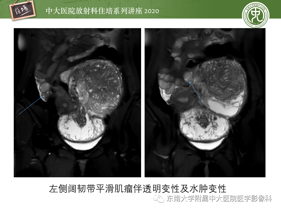 【PPT】女性盆腔实性占位性病变定位分析