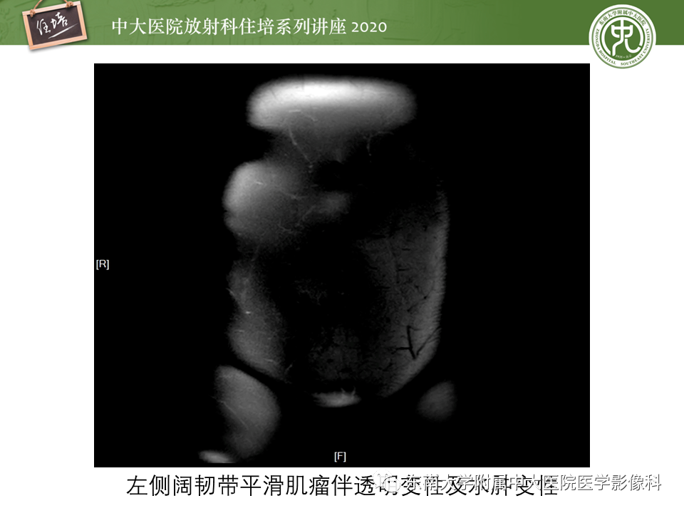 【PPT】女性盆腔实性占位性病变定位分析