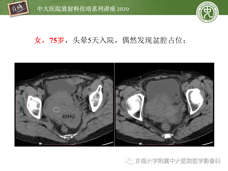 【PPT】女性盆腔实性占位性病变定位分析